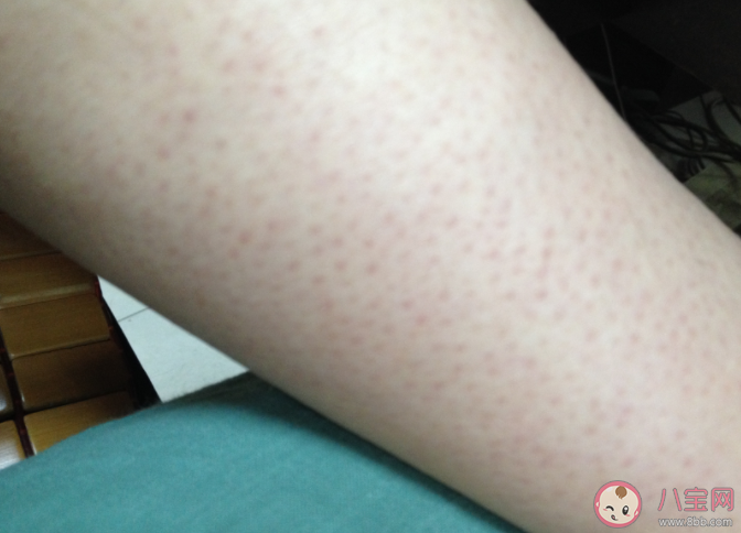 雞皮膚可以根治嗎 雞皮膚如何護理改善