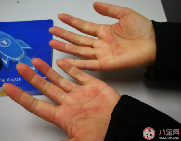 手指遇冷變紫怎么回事 手腳冰涼有哪些保暖小技巧 手指遇冷變紫怎么回事 手腳冰涼有哪些保暖小技巧