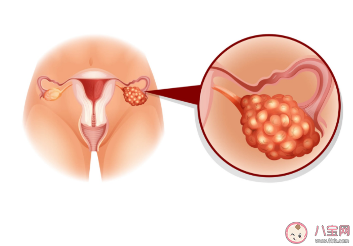 查出卵巢巧克力囊腫一定要手術嗎 卵巢巧克力囊腫對生育危害有多大 查出卵巢巧克力囊腫一定要手術嗎 卵巢巧克力囊腫對生育危害有多大