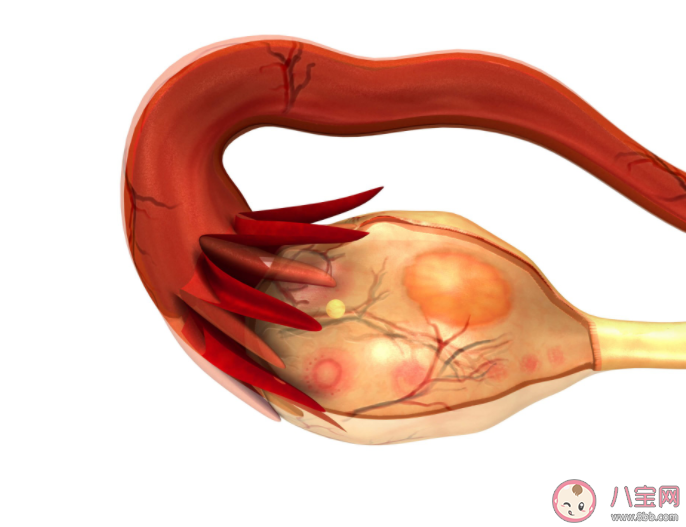 查出卵巢巧克力囊腫一定要手術嗎 卵巢巧克力囊腫對生育危害有多大 查出卵巢巧克力囊腫一定要手術嗎 卵巢巧克力囊腫對生育危害有多大