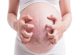 妊娠紋的發展過程是怎樣的 祛除妊娠紋的產品真的有效嗎