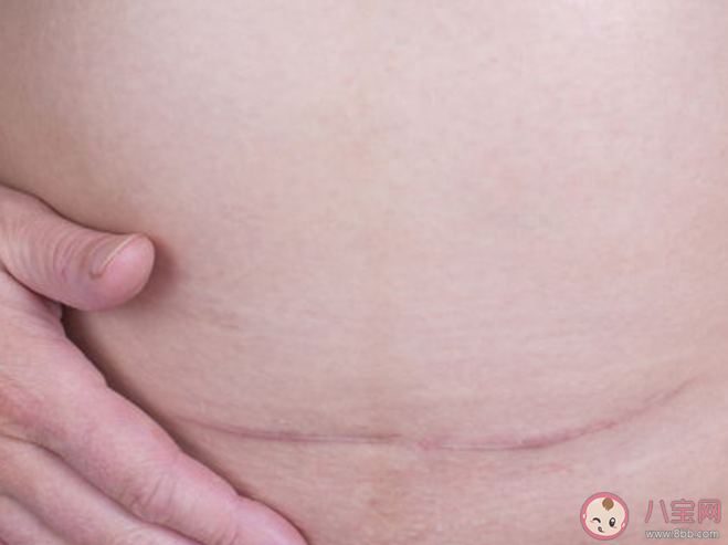 二胎剖腹產(chǎn)和第一胎剖腹產(chǎn)有什么區(qū)別 剖腹產(chǎn)媽媽生二胎注意什么