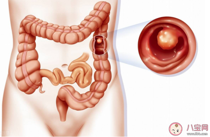 切除息肉疼不疼 腸息肉切除后怎么護理比較好 切除息肉疼不疼 腸息肉切除后怎么護理比較好