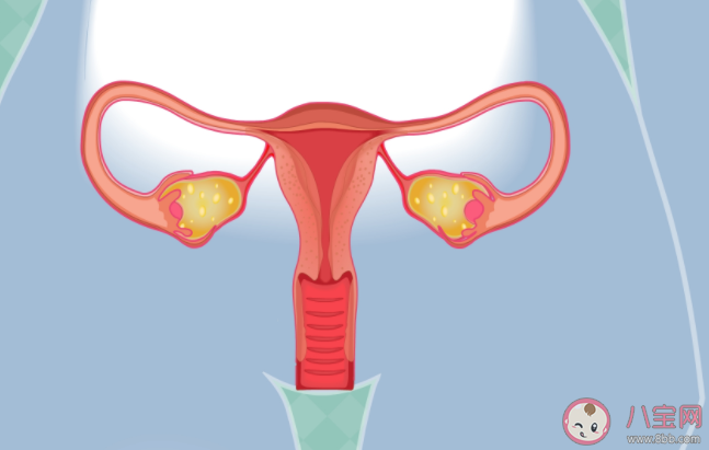 子宮內膜異位癥可以預防嗎 子宮內膜異位癥高危人群有哪些