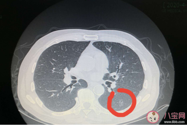 肺磨玻璃結(jié)節(jié)會(huì)演變成肺癌嗎 什么是肺部磨玻璃結(jié)節(jié)