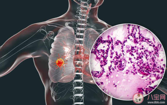 肺磨玻璃結(jié)節(jié)會(huì)演變成肺癌嗎 什么是肺部磨玻璃結(jié)節(jié)