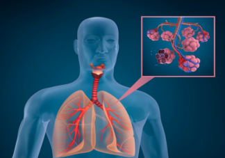 肺磨玻璃結節會演變成肺癌嗎 什么是肺部磨玻璃結節