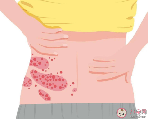 帶狀皰疹疫苗的接種方法是怎樣的 帶狀皰疹疫苗接種問題解答 帶狀皰疹疫苗的接種方法是怎樣的 帶狀皰疹疫苗接種問題解答