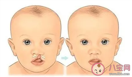 唇腭裂患兒剛做完手術可以吃哪一類食物 螞蟻莊園12月3日答案介紹