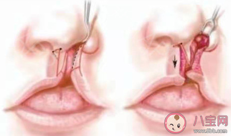 唇腭裂患兒剛做完手術可以吃哪一類食物 螞蟻莊園12月3日答案介紹