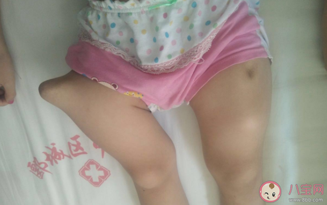 瓷娃娃病友可以正常上學工作嗎 螞蟻莊園12月7日正確答案 瓷娃娃病友可以正常上學工作嗎 螞蟻莊園12月7日正確答案