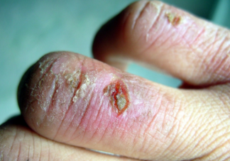 烤火喝酒治凍瘡可取嗎 哪些人容易長凍瘡