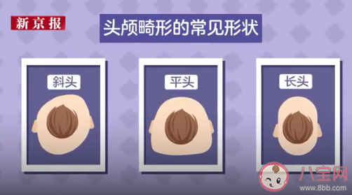 網紅矯正頭盔或影響嬰兒發育 定型枕定型頭盔有用嗎 網紅矯正頭盔或影響嬰兒發育 定型枕定型頭盔有用嗎