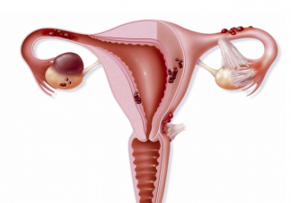 有卵巢囊腫可以懷孕嗎 沒(méi)有性生活也會(huì)得卵巢囊腫嗎