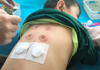 三九貼里都是什么藥 貼三九貼要注意什么