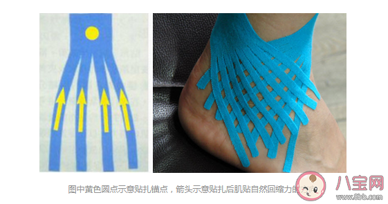哪些情形可以用肌內效貼 肌貼到底應該怎么用 哪些情形可以用肌內效貼 肌貼到底應該怎么用