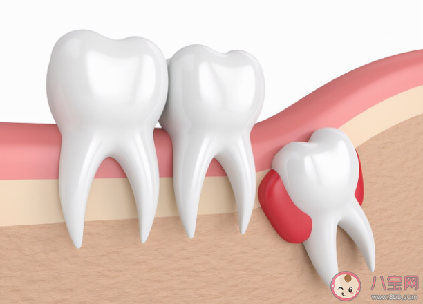 智齒是如何被拔出的 哪種智齒必須要拔 智齒是如何被拔出的 哪種智齒必須要拔