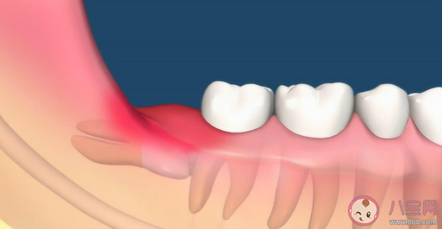 智齒是如何被拔出的 哪種智齒必須要拔 智齒是如何被拔出的 哪種智齒必須要拔