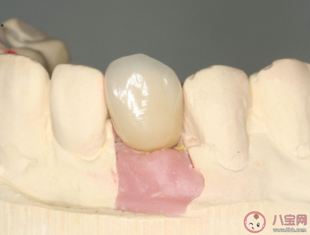 種植牙就要選最貴的嗎 種植牙如何護理 種植牙就要選最貴的嗎 種植牙如何護理