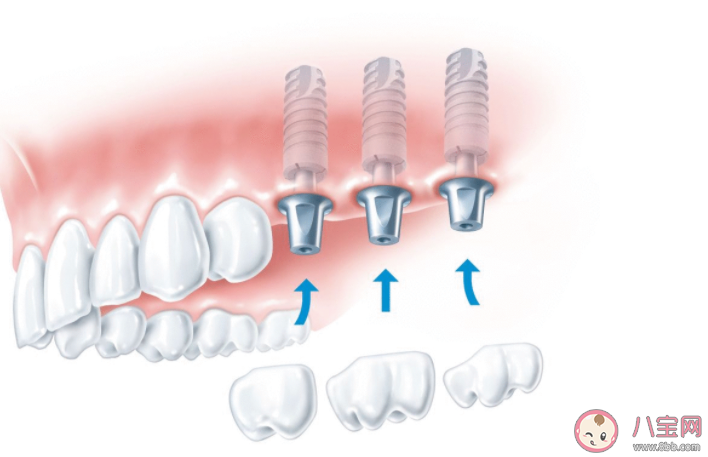 種植牙就要選最貴的嗎 種植牙如何護理 種植牙就要選最貴的嗎 種植牙如何護理