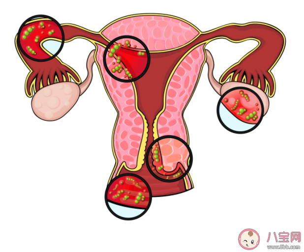 盆腔里的積液怎么排出來 盆腔積液是盆腔炎嗎