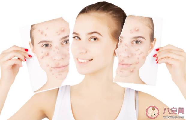 長痘痘和性生活有關系嗎 青春期痘痘和成人痘有什么不同