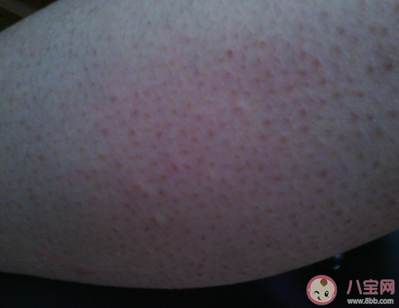 雞皮膚摳了就能好嗎 雞皮膚可以根治嗎