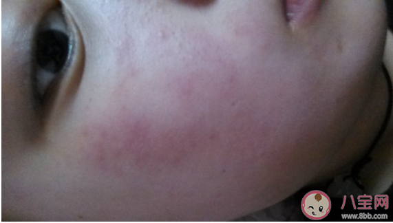 什么季節容易長濕疹 做好哪些事能有效預防濕疹