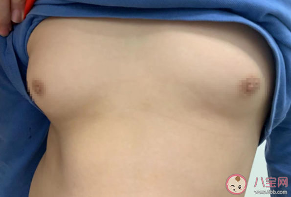 11歲男孩乳房發育直徑超4厘米是怎么回事 男性乳房發育正常嗎