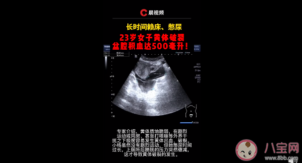 憋尿會導致黃體破裂嗎 黃體破裂的原因有什么 憋尿會導致黃體破裂嗎 黃體破裂的原因有什么