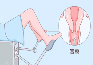 打HPV疫苗還要做宮頸癌篩查嗎 為什么很多女性有宮頸癌焦慮