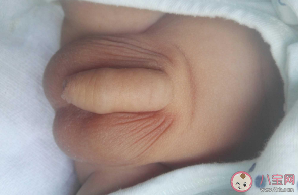 孩子蛋蛋不一樣大正常嗎 睪丸大小不一怎么辦