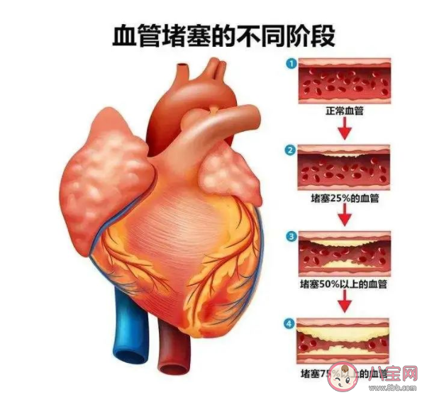 讓血管變堵的5大罪魁禍首 血管堵塞會帶來什么影響 讓血管變堵的5大罪魁禍首 血管堵塞會帶來什么影響