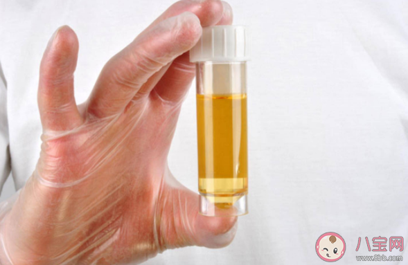 常用尿酸檢查方法有哪些 尿酸需要反復檢查嗎