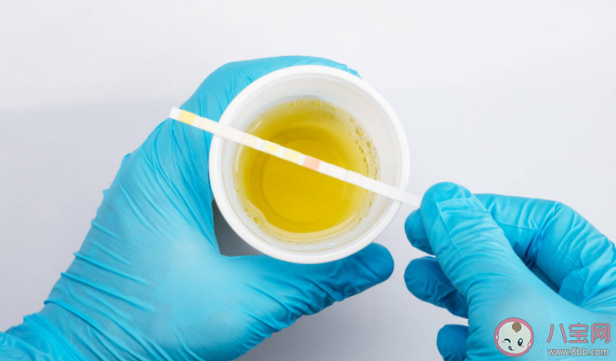 常用尿酸檢查方法有哪些 尿酸需要反復檢查嗎