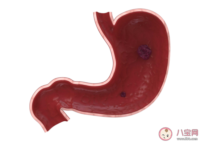 做胃鏡一個人去可以嗎 胃鏡能查出什么病