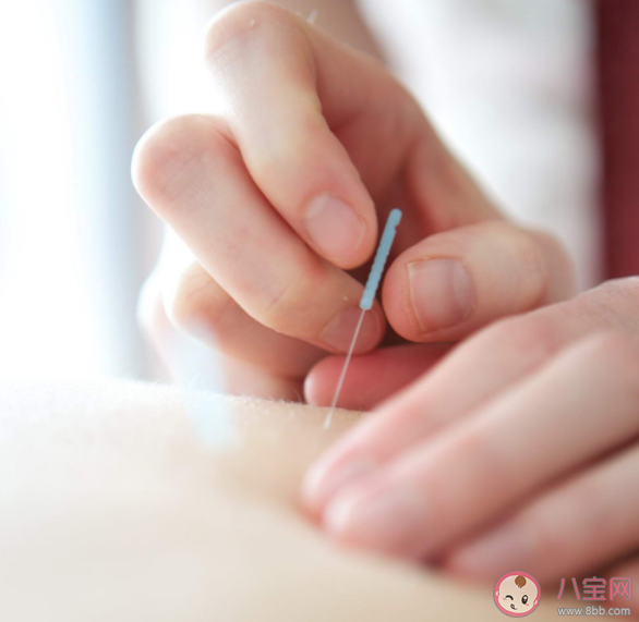 針灸擅長治療哪些病 針灸安全嗎 針灸擅長治療哪些病 針灸安全嗎