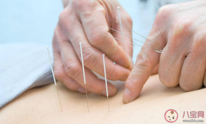 針灸后多久能洗澡 針灸有哪些禁忌