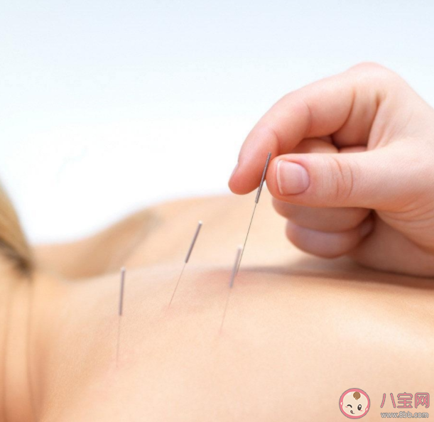 針灸后多久能洗澡 針灸有哪些禁忌