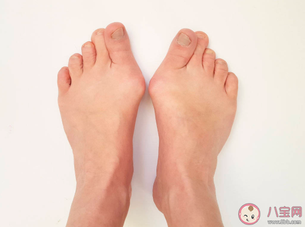 穿高跟鞋會(huì)導(dǎo)致拇外翻嗎 如何預(yù)防拇外翻