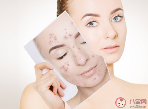 青春痘和青春有關系嗎 長青春痘怎么做好得快