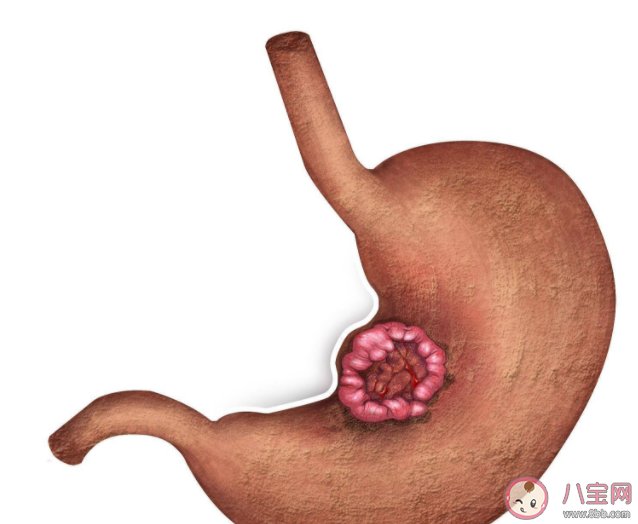 我們的胃到底是怎么壞的 5個方法護胃健康