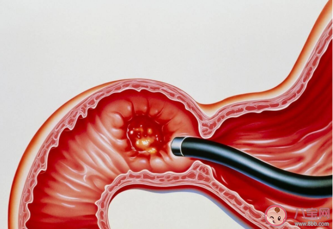 我們的胃到底是怎么壞的 5個方法護胃健康