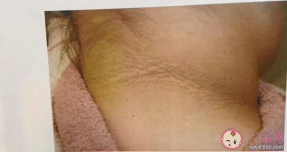 為何有些肥胖人士脖子老是洗不干凈 黑棘皮病嚴重嗎危害大不大