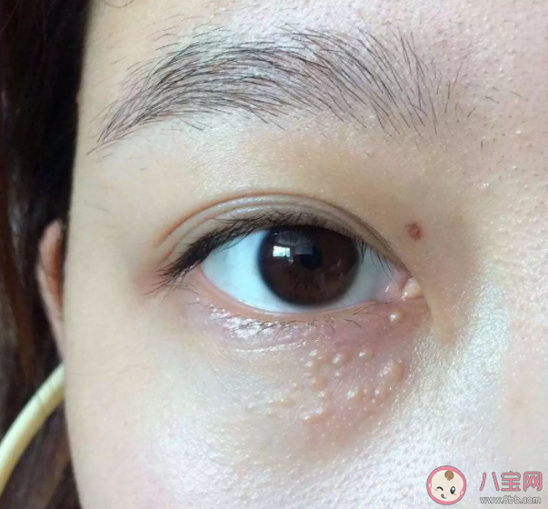 脂肪粒需要治療嗎 眼睛周圍的脂肪粒該怎么去除