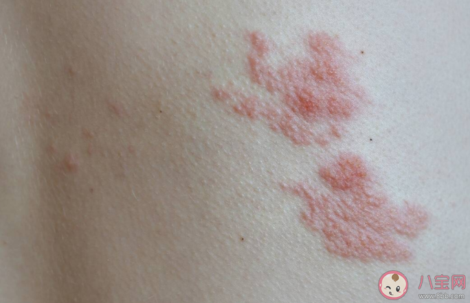 水痘和帶狀皰疹有什么區(qū)別 沒(méi)得過(guò)水痘會(huì)得帶狀皰疹嗎