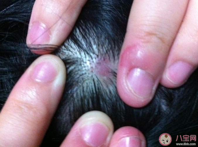 頭皮上的痂是什么 為何頭皮上總是長(zhǎng)疙瘩和膿包