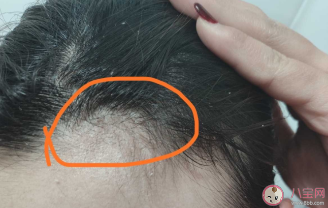 反復頭屑的原因是什么 頭屑過多如何洗頭用藥 反復頭屑的原因是什么 頭屑過多如何洗頭用藥