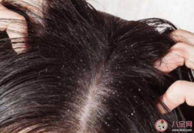 反復頭屑的原因是什么 頭屑過多如何洗頭用藥 反復頭屑的原因是什么 頭屑過多如何洗頭用藥