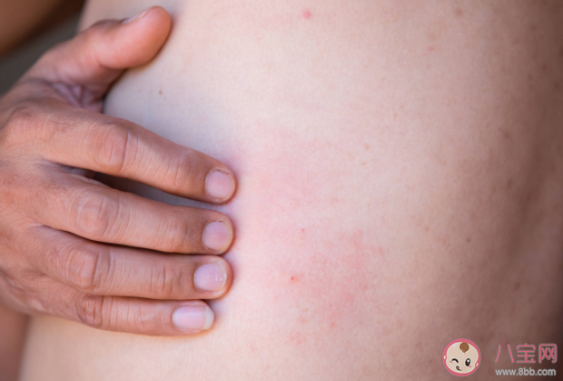 帶狀皰疹能自愈為什么要預(yù)防 帶狀皰疹疫苗為什么50歲以上才能接種